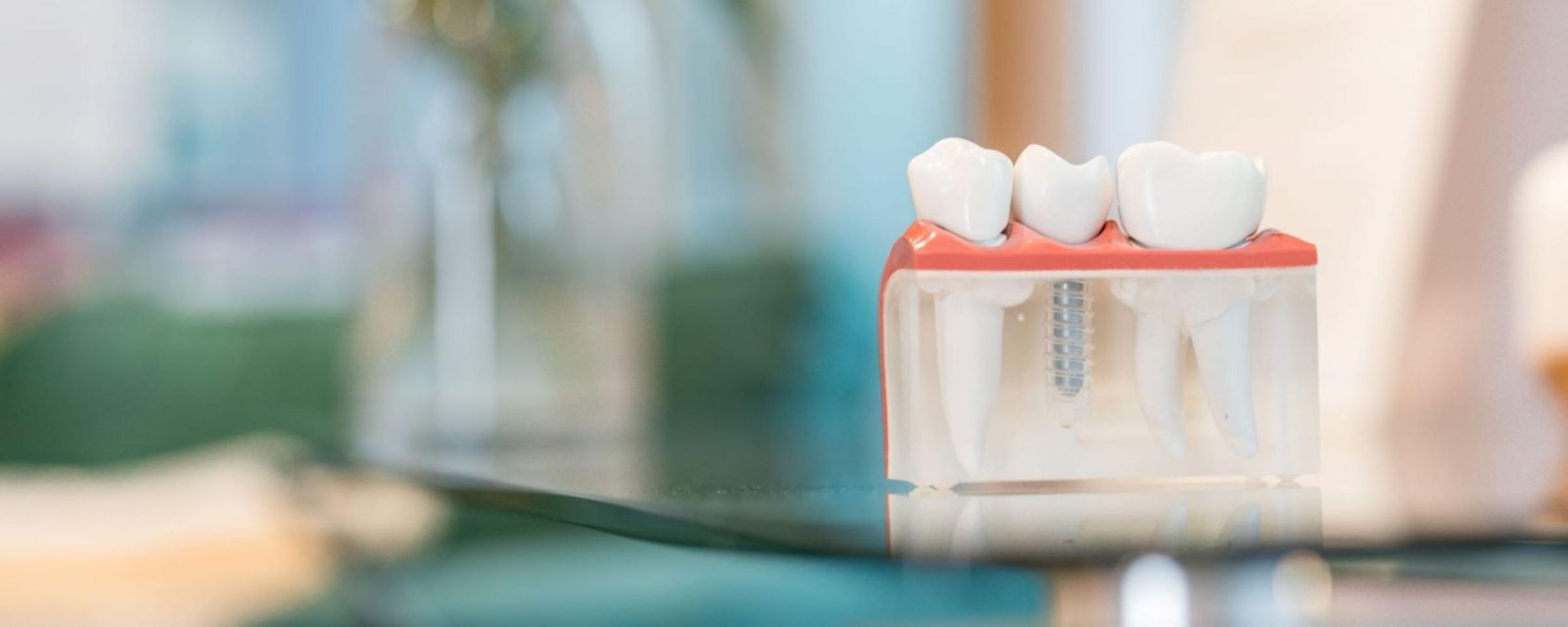 Dental Implants. Are They Worth It?