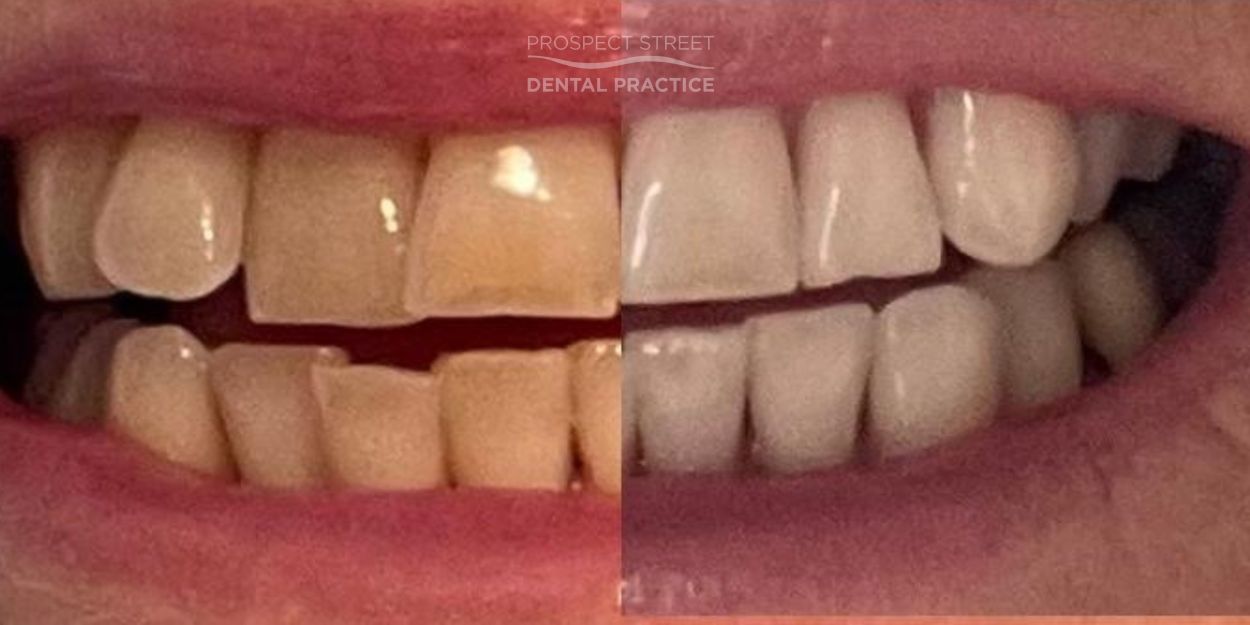 Whitening