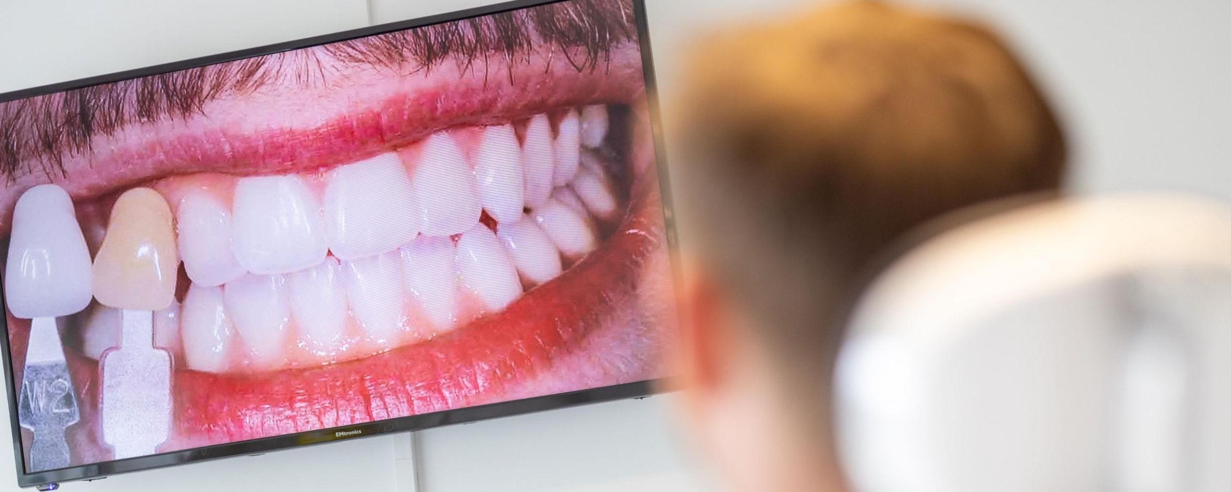 Professional Teeth Whitening vs. Beauty Salon Whitening