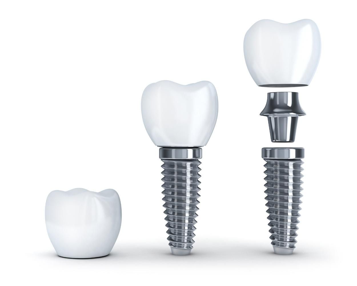 Dental Implants Components